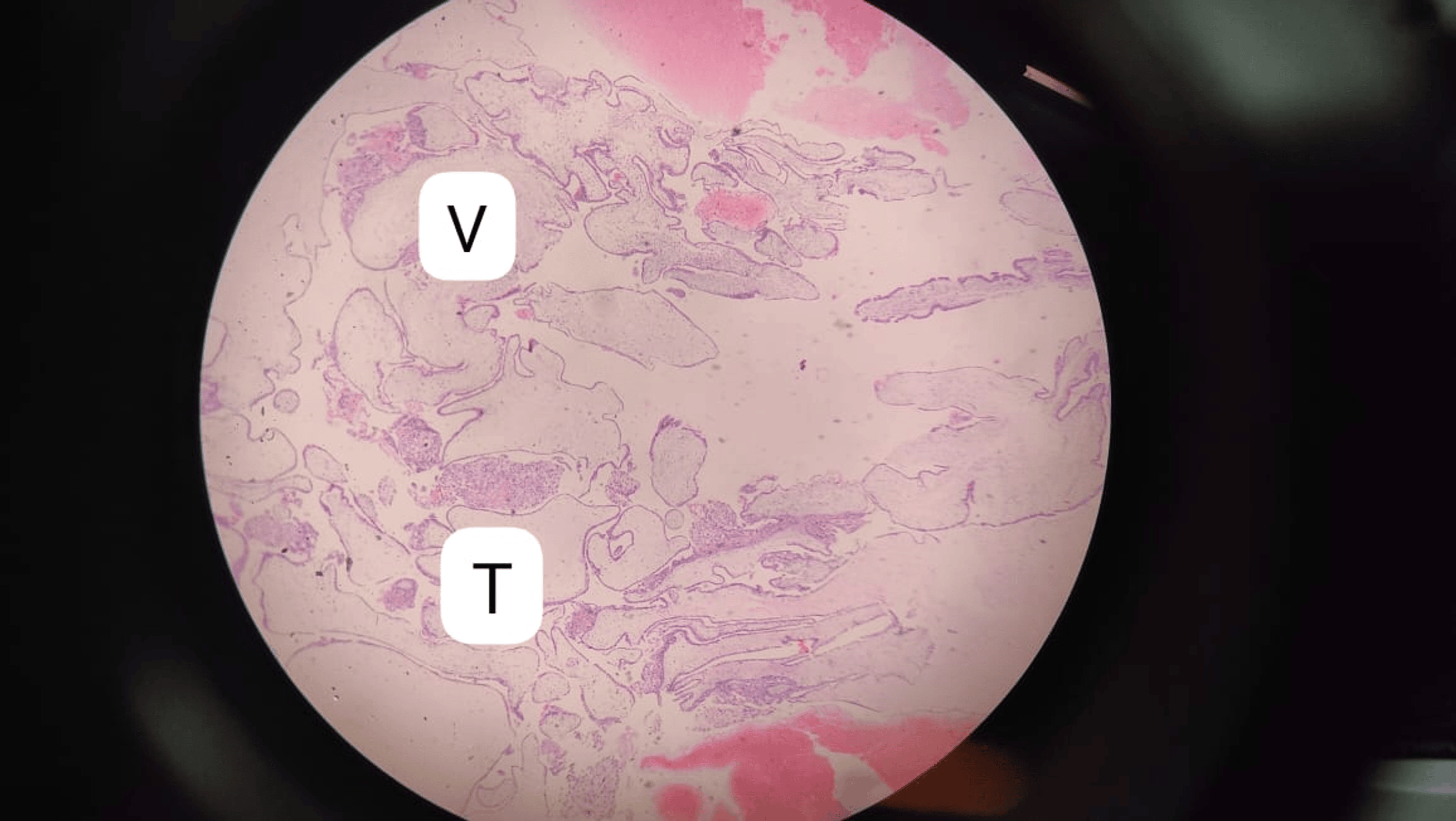 A Complete Hydatidiform Mole Complicated by Theca Lutein Cysts in a