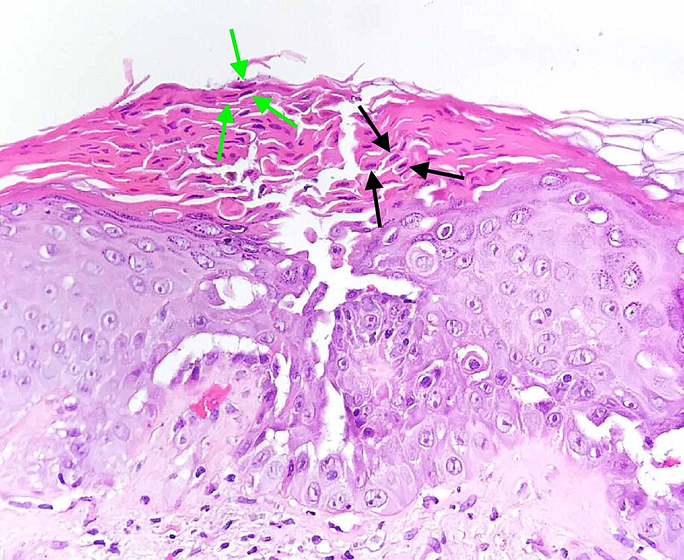 Cureus | Darier Disease – A Clinical Illustration of Its High Variable ...