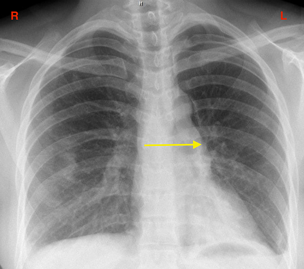 Opacification-in-the-left-lung-(yellow-arrow).