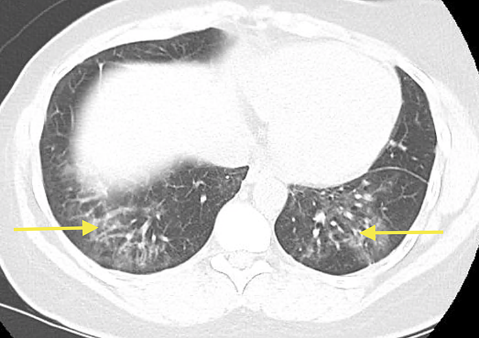 Bilateral-mid-lower-lung-zone-reticulonodular-opacities-(yellow-arrows).