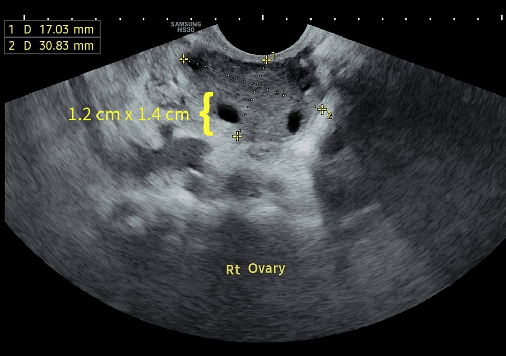 Ovarian Cysts 101 - Penn Medicine