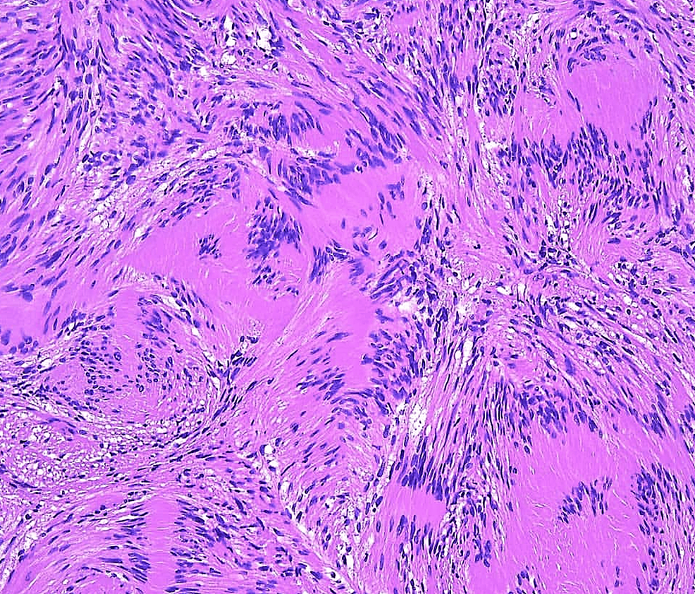 Facial Neuropathy Revealed A Case Report On Trigeminal Schwannoma Cureus