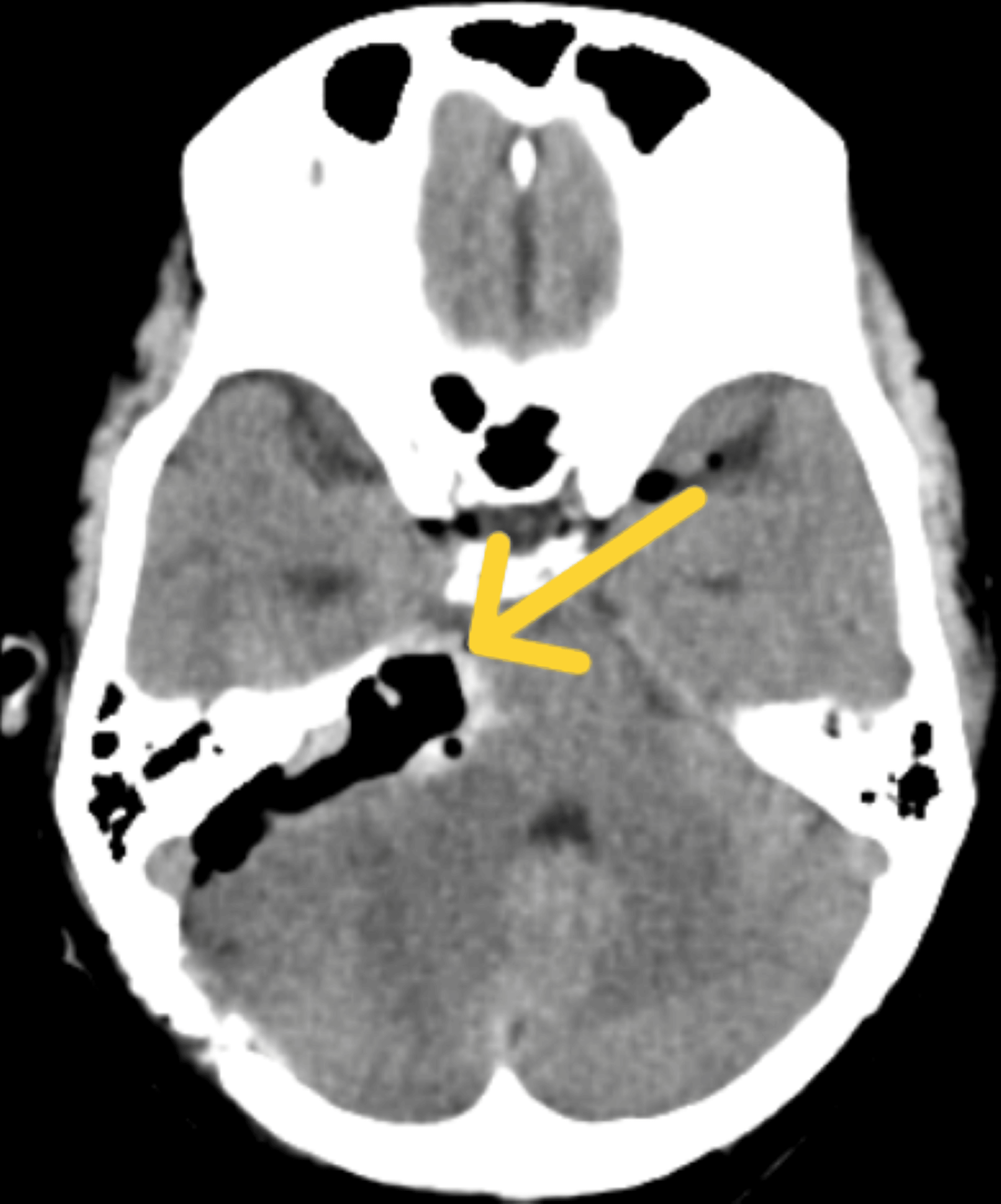 Cureus Physiotherapy Rehabilitation Following Acoustic Neuroma