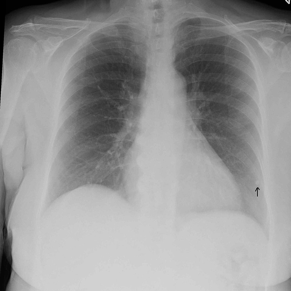 Chest-radiograph-demonstrating-stable-calcified-granuloma-(arrow)