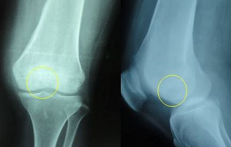 Cureus Arthroscopically Assisted Evacuation of Brodie s Abscess