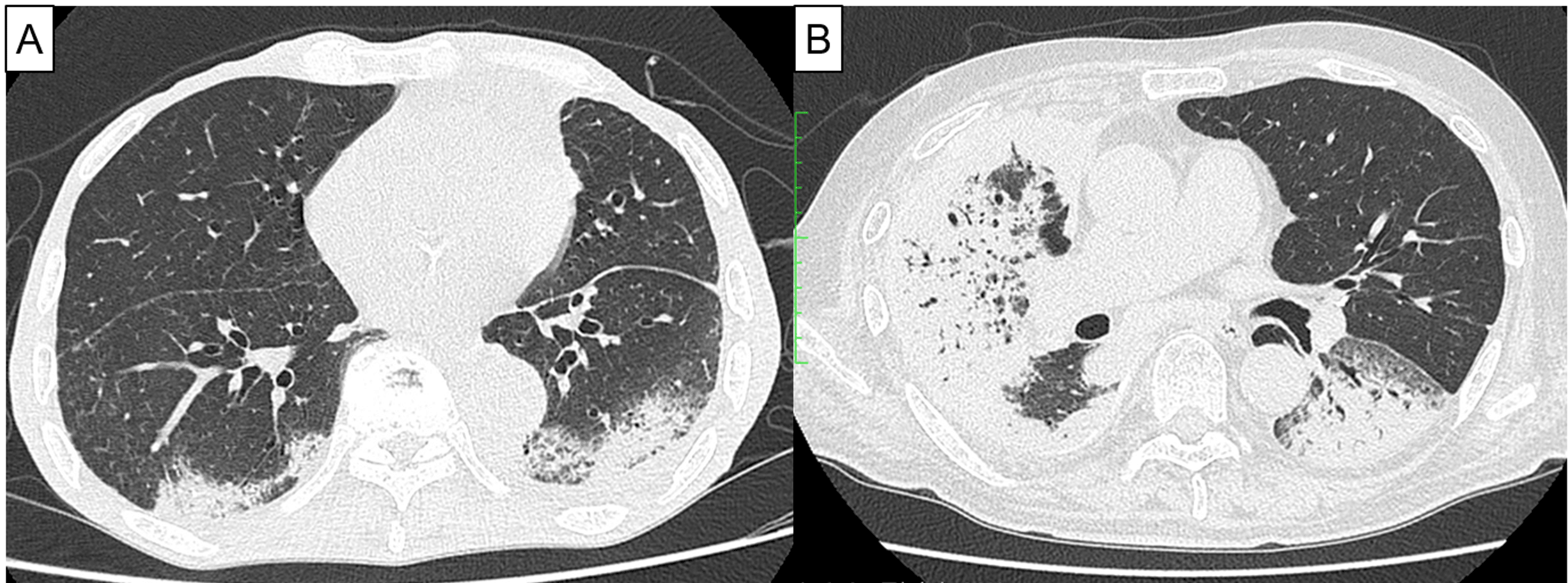 Safety of FirstLine Nivolumab Plus Ipilimumab in Very Old (≥ 80 Years