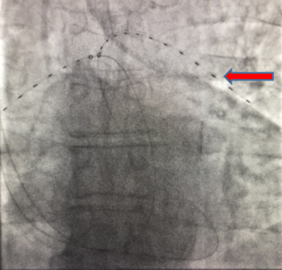 Cureus The Role of EkoSonic Endovascular System or EKOS® in Pulmonary