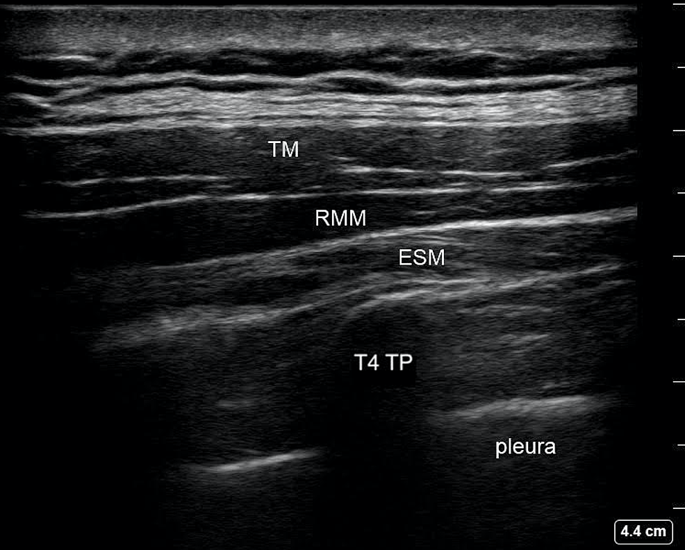 T4-Erector-Spinae-Plane-Block-Ultrasound-Anatomy