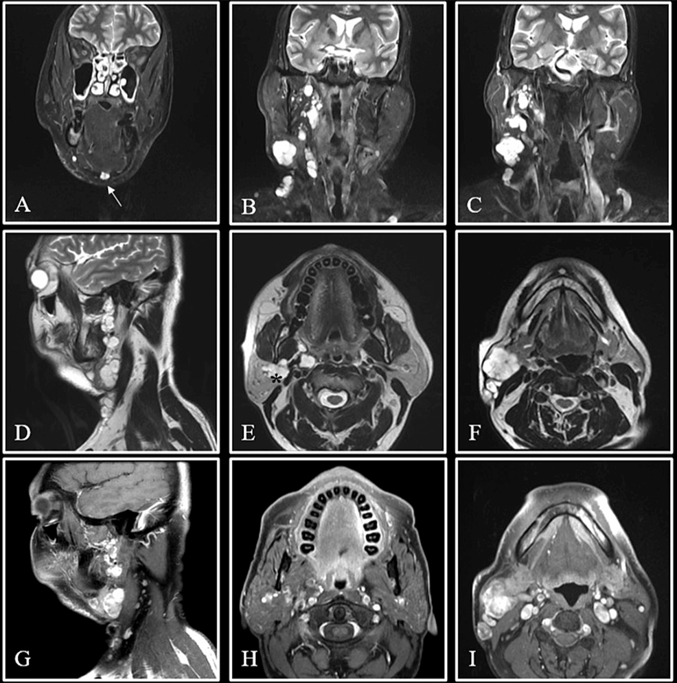 Cureus, Sequelae of a Rare Case of Penetrating Parotid Gland Injury:  Ultrasound and Magnetic Resonance Imaging Features