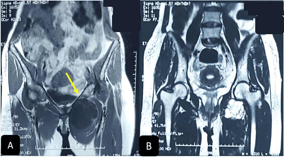 Cureus Hydatid Cyst of the Inguinal Region An Exceptional Localization