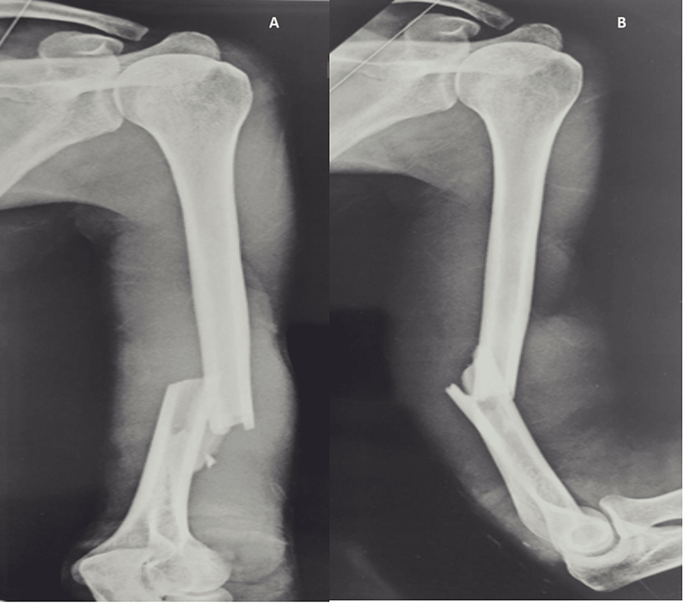 Cureus, A Retrospective Analysis of Dynamic Compression Plating Versus  Intramedullary Nailing for the Management of Shaft of Humerus Fractures in  an Urban Trauma Care Center