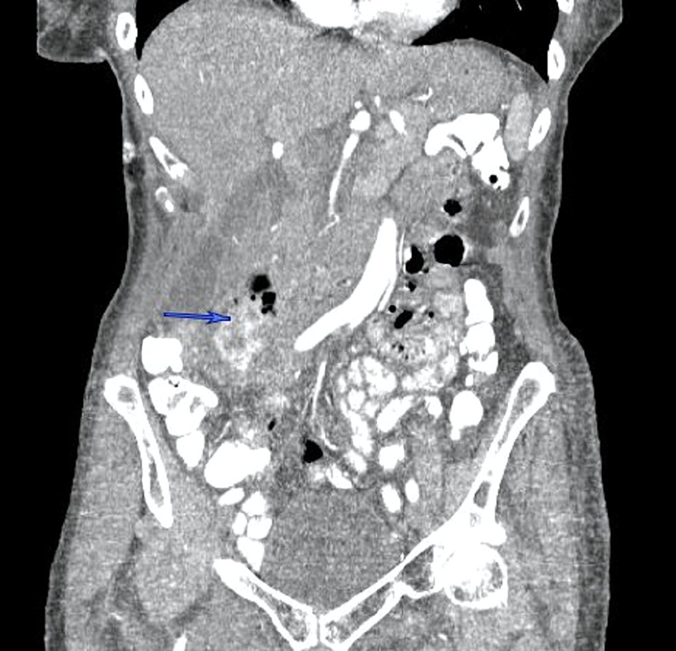 CT-abdomen-(coronal-section)-demonstrates-a-complex-collection-with-a-contained-contrast-leak-related-to-the-perforated-duodenal-diverticulum