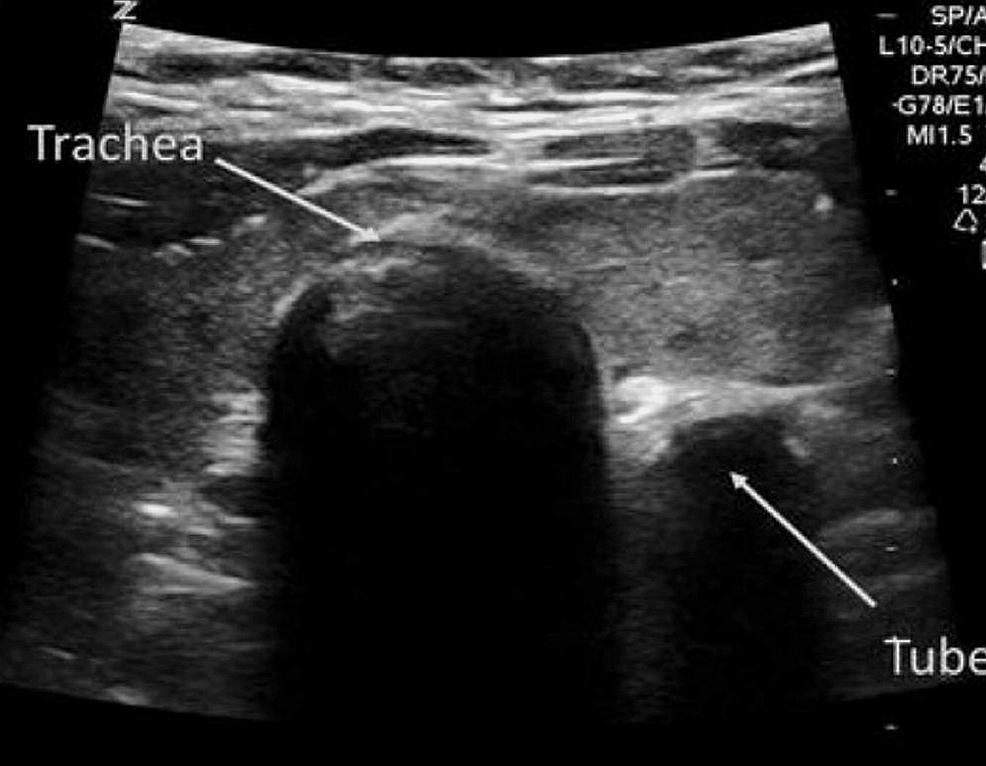 Comparison of Upper Airway Ultrasonography Against Quantitative