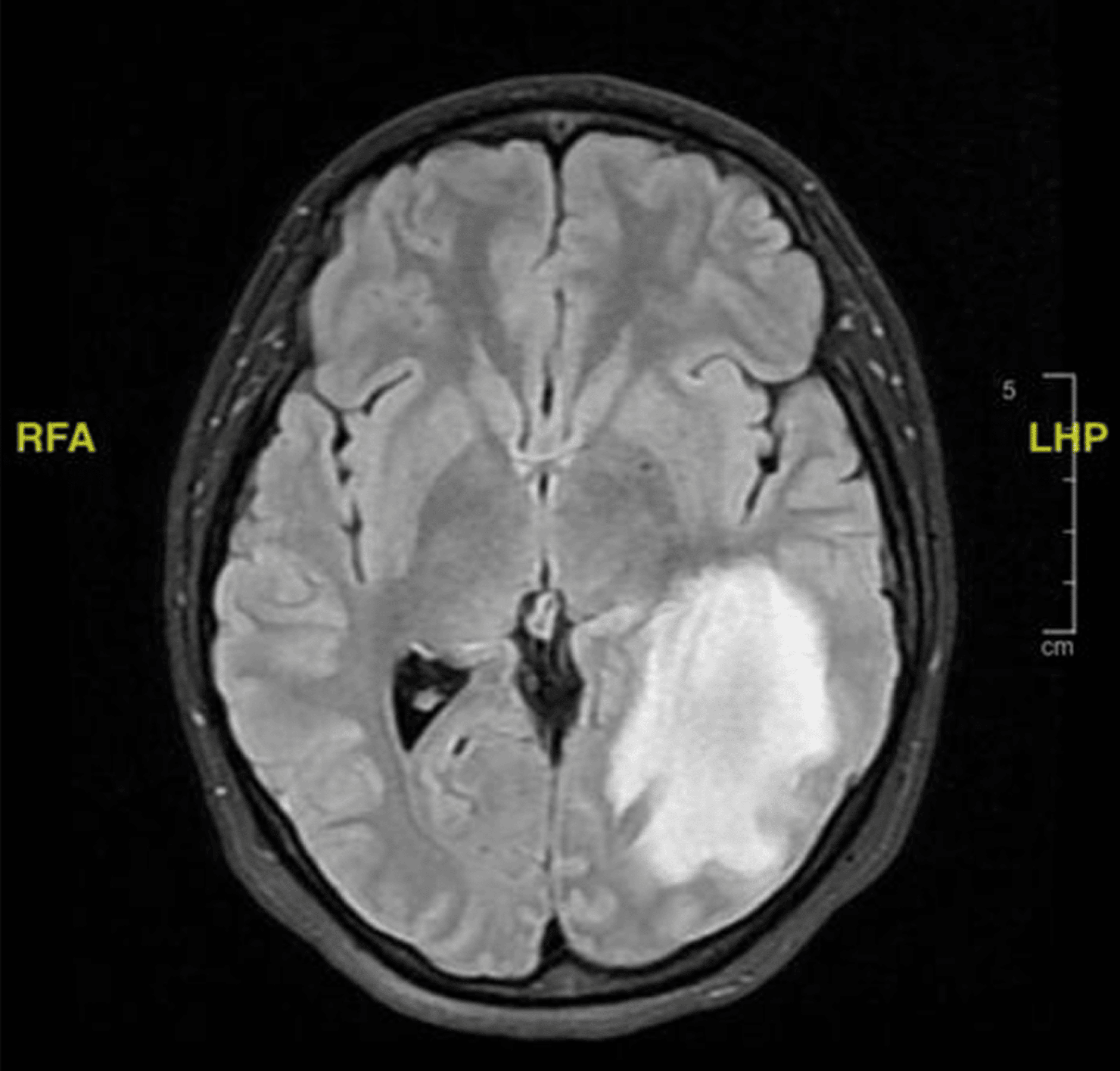 cureus-idiopathic-intracranial-hypertension-preceding-tumefactive