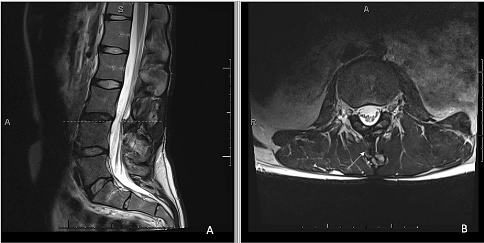 Position-Dependent Intrathecal Baclofen System Catheter Failure ...