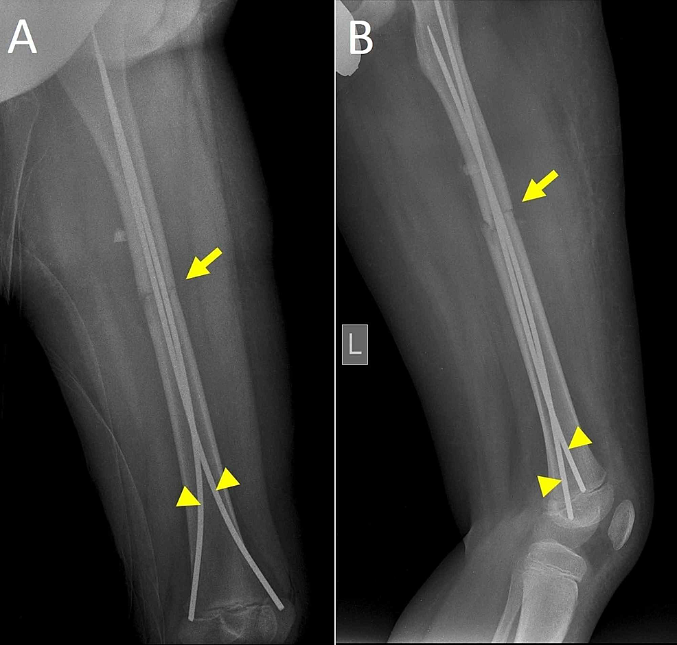 Cureus | Leg Length Discrepancy Due to Loss of Femoral Antecurvatum ...