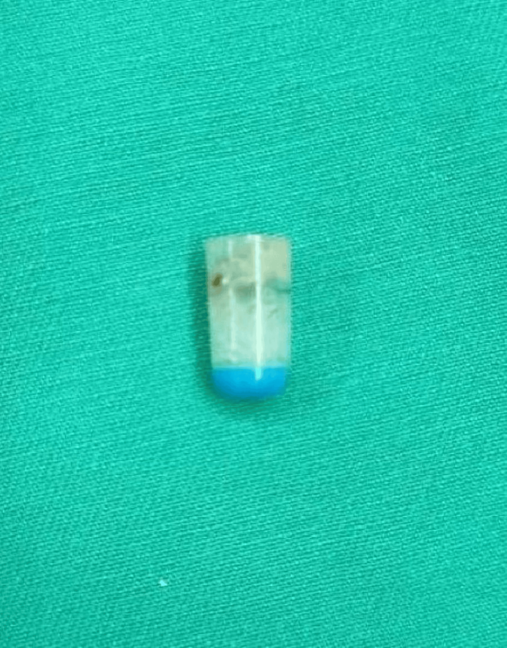 Cureus A Foreign Body Aspiration Leading to Pneumothorax A Case of