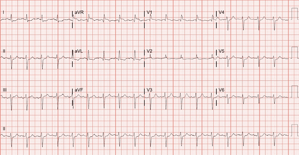 Cardiogenic Shock In A Patient With 4G 4G PAI Polymorphism And MTHFR cardiogenic-shock-in-a-patient-with-4g-4g-pai-polymorphism-and-mthfr