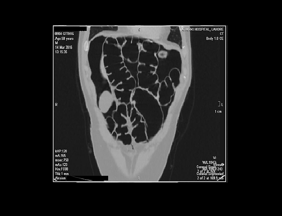 A-coronal-section-of-the-CT-abdomen-showing-pneumo-peritoneum-along-with-pneumatosis-intestinalis-and-thick-reactive-intestine-walls.-The-radiologic-presentation-assures-the-presence-of-air-in-the-gut,-which-can-be-due-to-a-perforation.-