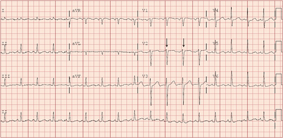 Cureus | Bicuspid Aortic Valve Endocarditis Caused by Streptococcus ...