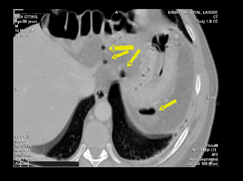 CT-scan-of-the-abdomen-(axial-segment):-pneumo-peritoneum-and-a-few-air-pockets-(yellow-arrows)-are-appreciated-around-the-stomach,-which-may-be-most-likely-a-result-of-gastric-perforation.