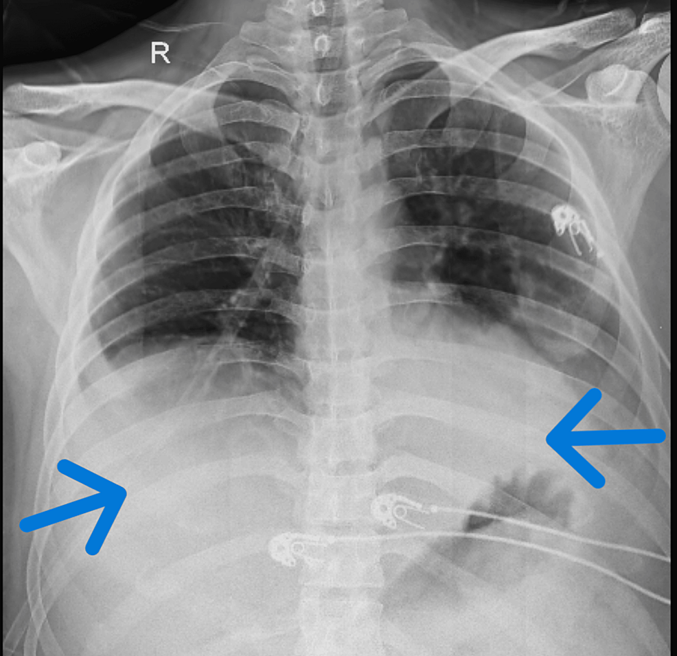 A Comprehensive Physiotherapeutic Approach in a Young Patient With ...