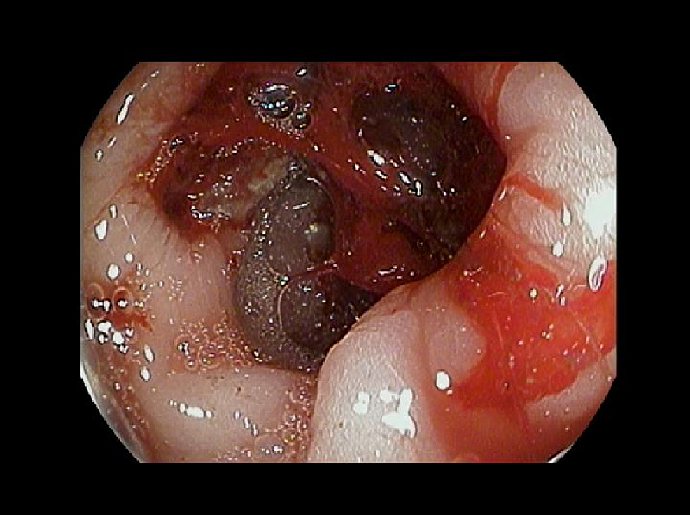 The-endoscopic-picture-at-the-second-part-of-the-duodenum-showing-blood-oozing-from-the-perforated-site,-although-the-omentum-covered-the-site-of-perforation.-The-perforation-is-in-the-posterior-wall-of-the-duodenum-and-is-most-likely-at-the-junction-of-the-second-and-third-part.