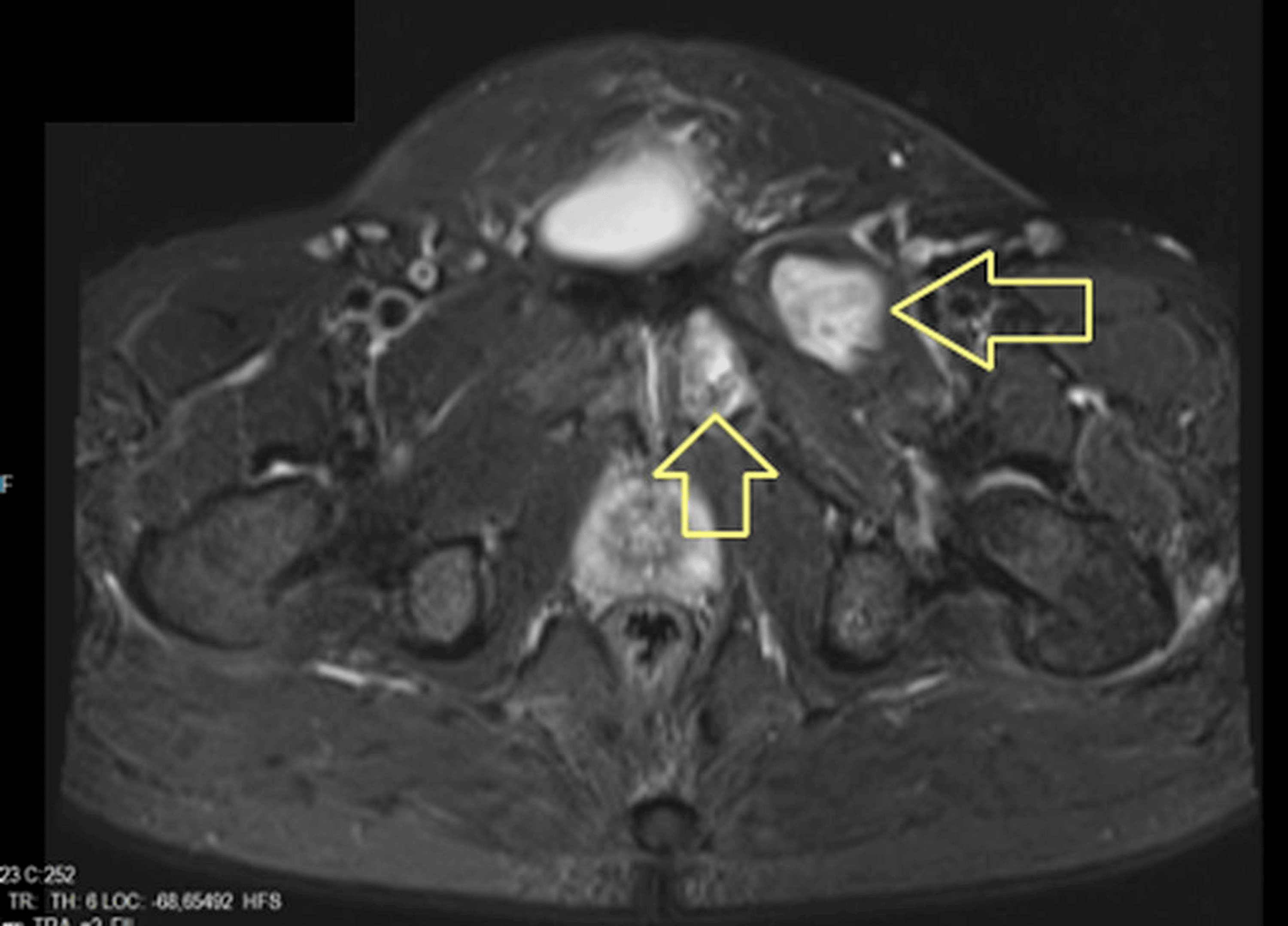 Cureus A Rare Presentation of Hydatid Cyst A Case Report of Localization in the