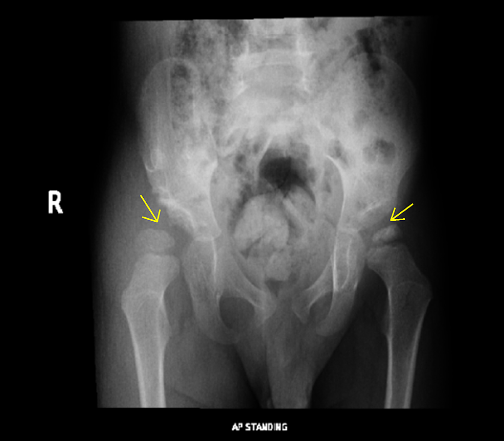 Cureus, Developmental Dysplasia of the Hip with Concurrent  Legg-Calvé-Perthes Disease in the Contralateral Hip