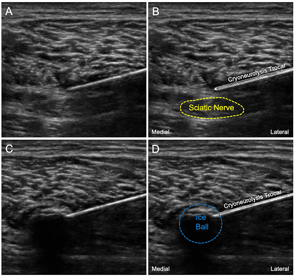 Ultrasound Guided Percutaneous Cryoneurolysis For Perioperative Analgesia Following Major Lower