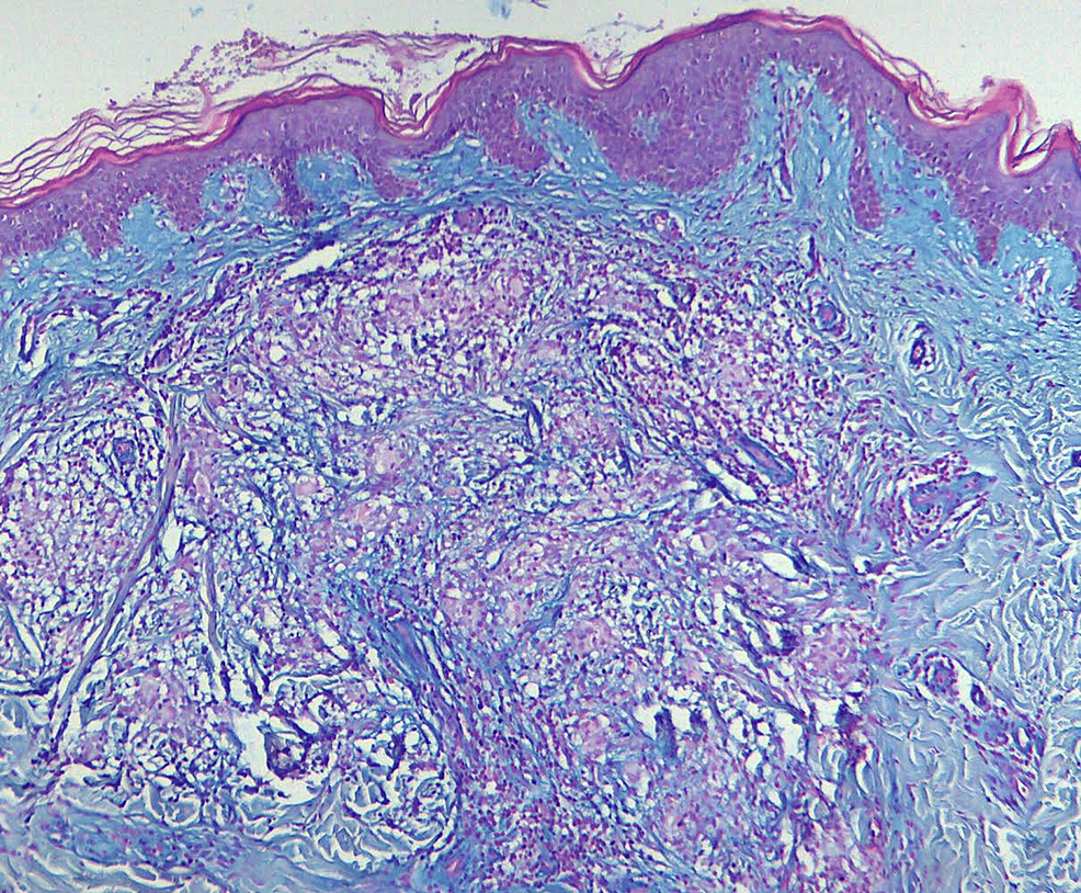 A Rare Association Of Disseminated Granuloma Annulare With Recurrent ...