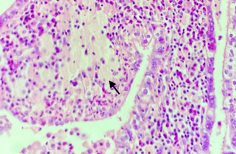 Xanthogranulomatous Inflammation Of The Female Genital