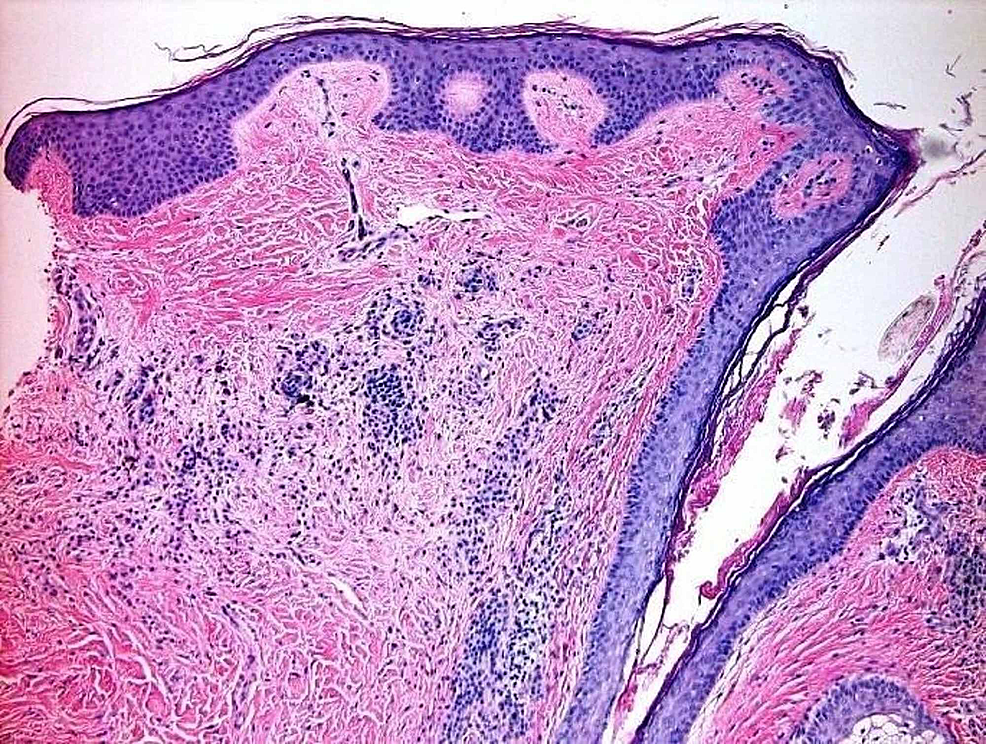 One-6.0-mm-punch-biopsy-of-the-right-superior-occipital-scalp-was-obtained-for-H&E,-which-showed-subtle,-non-scarring,-non-inflammatory-alopecia;-this-could-represent-telogen-effluvium.-The-absence-of-significant-miniaturization-is-evidence-against-androgenic-alopecia.-