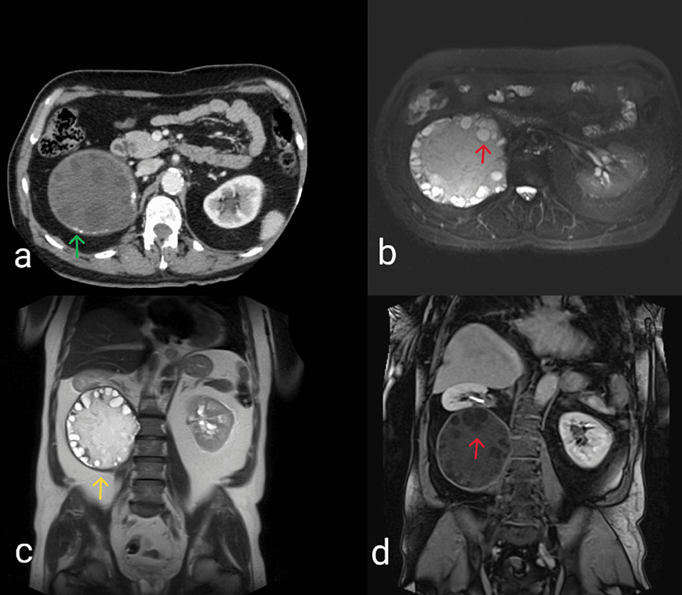 Primary Retroperitoneal Echinococcal Cyst Treated With a Total ...