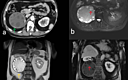 Primary Retroperitoneal Echinococcal Cyst Treated With a Total ...