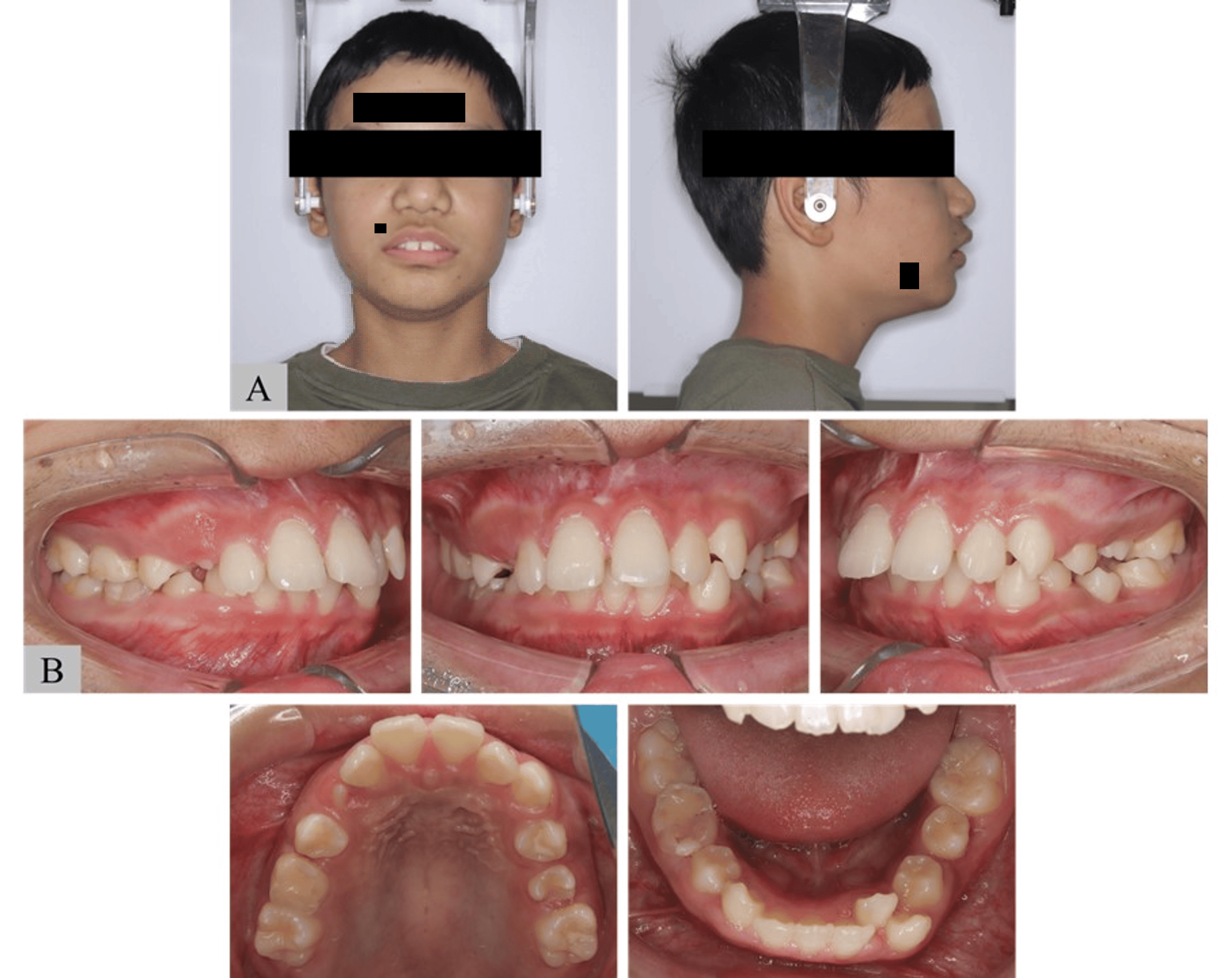 Characteristics of Craniofacial Morphology and Occlusion in Shwachman