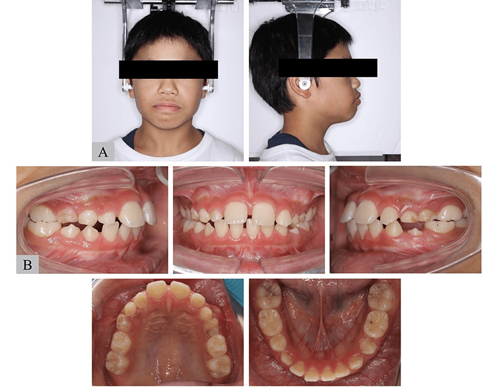Characteristics of Craniofacial Morphology and Occlusion in Shwachman