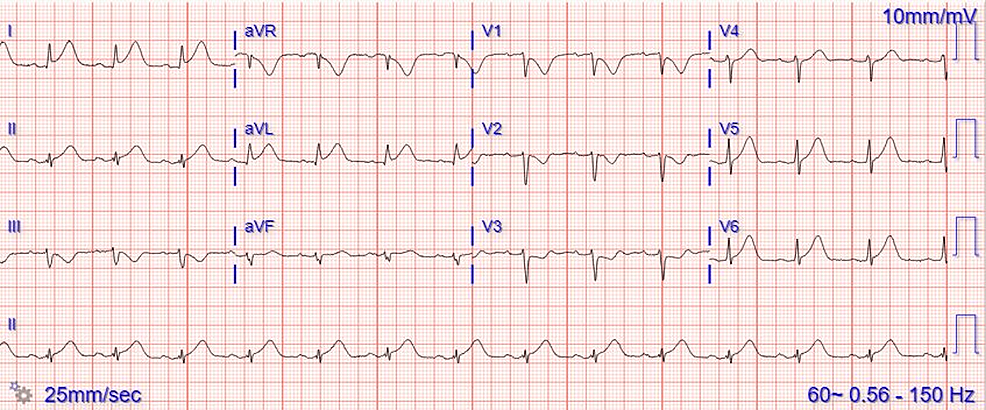 Cureus | ST-Segment Elevation Myocardial Infarction Caused by 5 ...