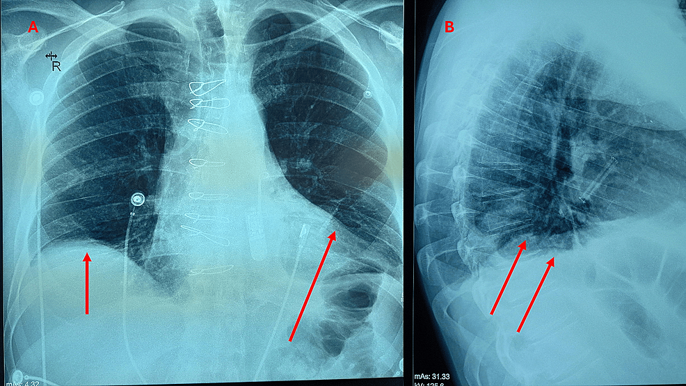 Symptoms Arising From the Diaphragm Muscle Function and Dysfunction