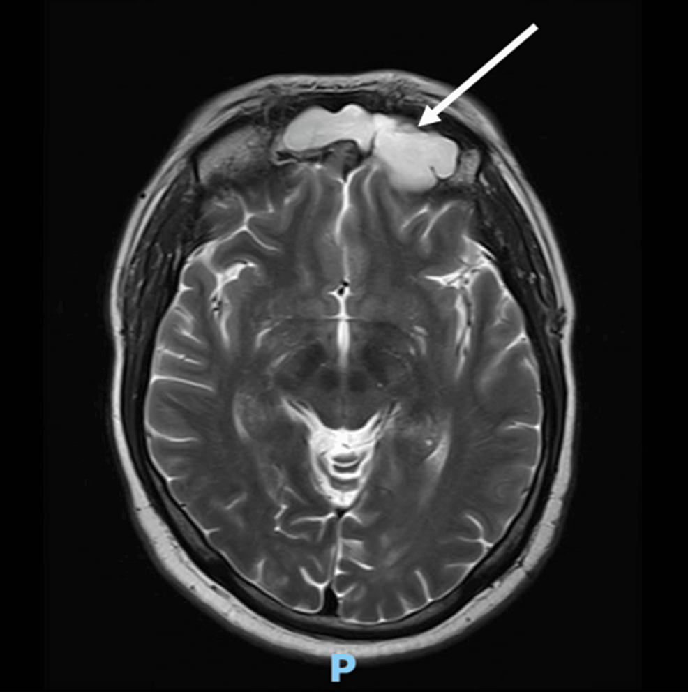 A-brain-MRI-(T1-weighted;-without-contrast;-sagittal-plane)-shows-a-soft-tissue-lesion-located-in-the-midline-olfactory-groove-area.-Dural-surface-with-extension-into-anterior-frontal-dura.
