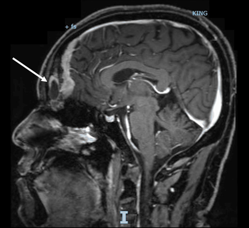 A-brain-MRI-(T2-weighted;-without-contrast;-axial-plane)-shows-a-soft-tissue-lesion-located-in-the-midline-olfactory-groove-area.
