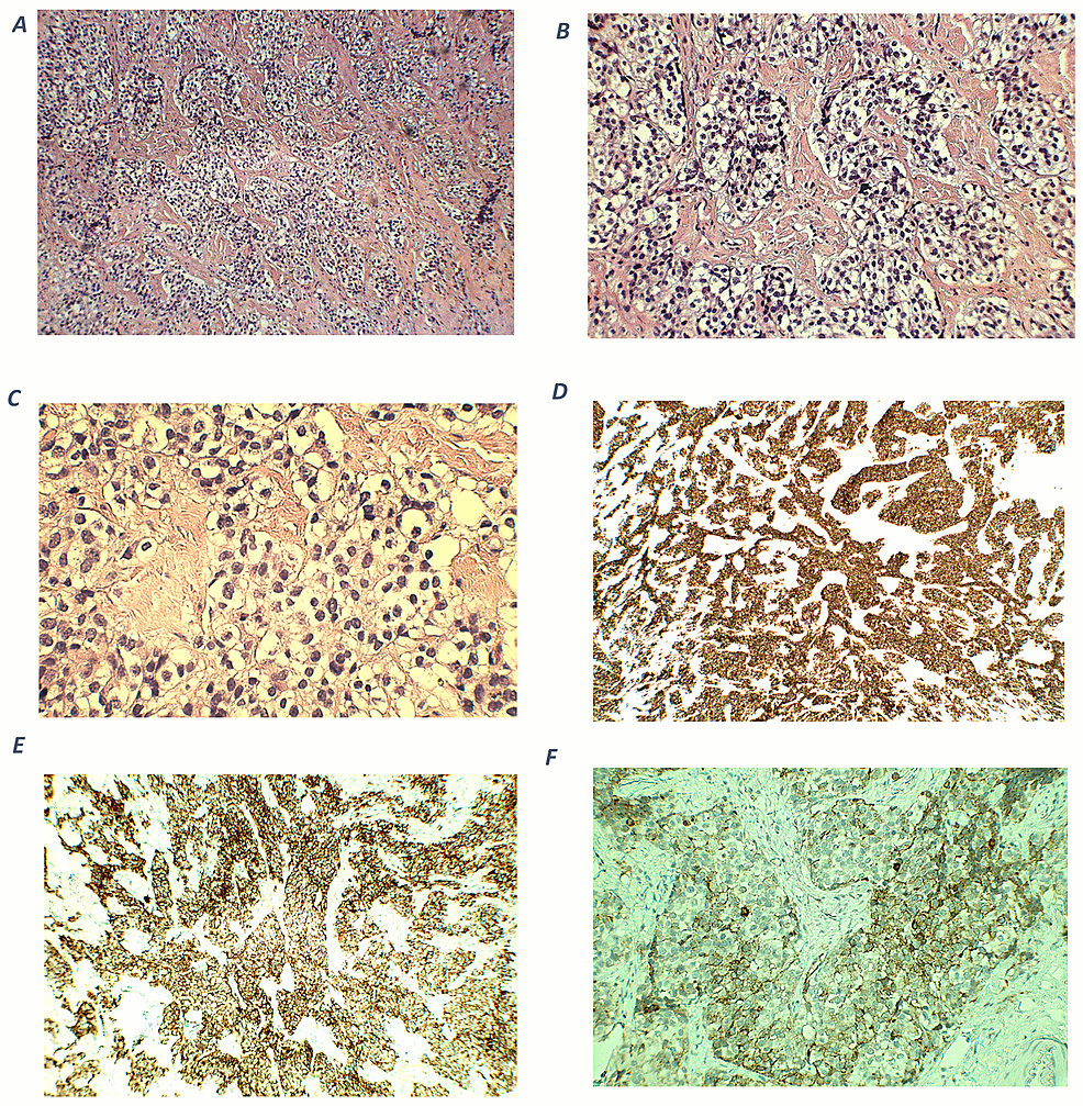 Histopathological-and-immunohistochemical-findings-of-olfactory-neuroblastoma.