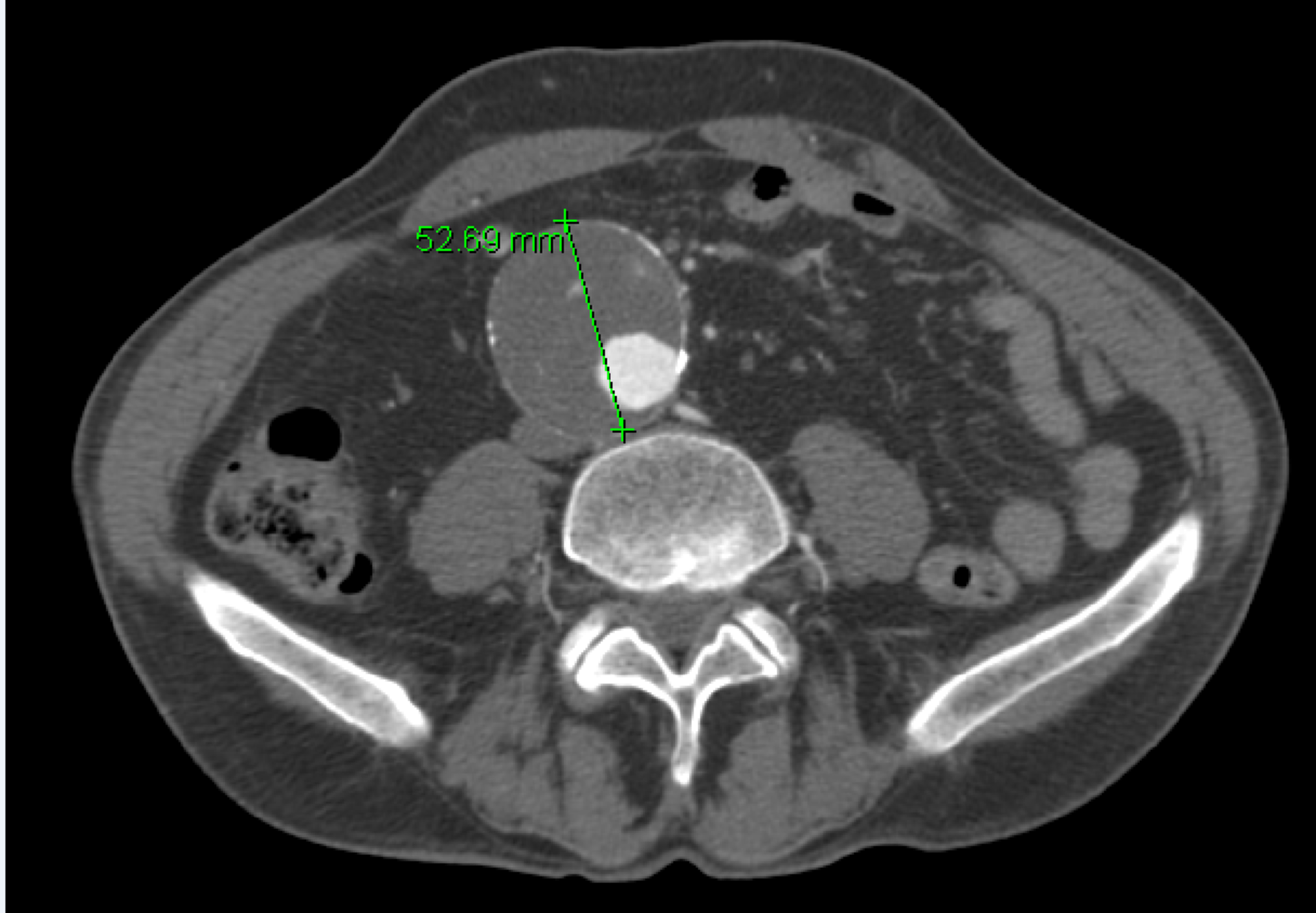 Horseshoe Kidney Isthmus Infarction After Percutaneous Endovascular
