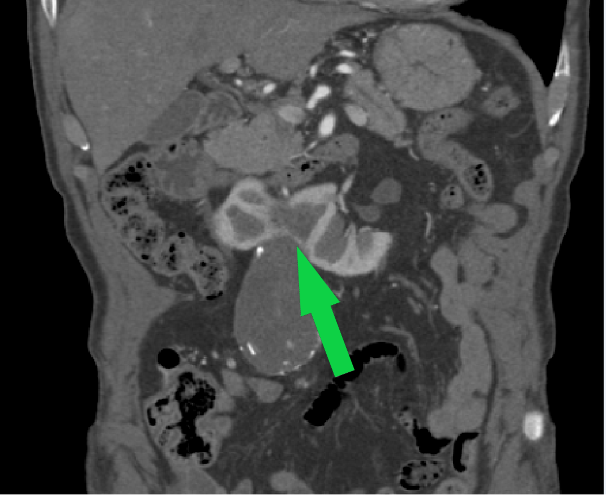 Cureus Horseshoe Kidney Isthmus Infarction After Percutaneous