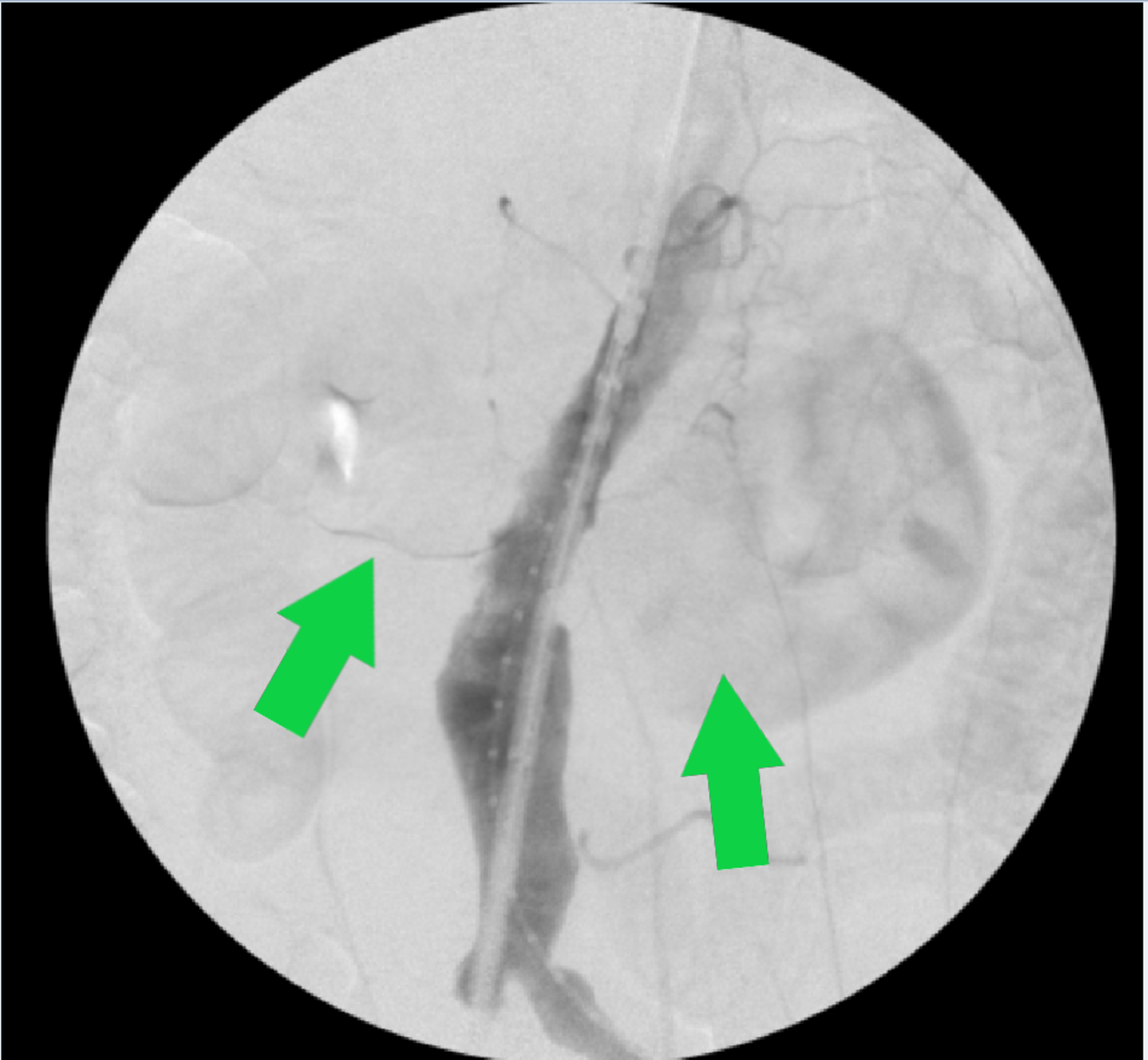 Cureus Horseshoe Kidney Isthmus Infarction After Percutaneous