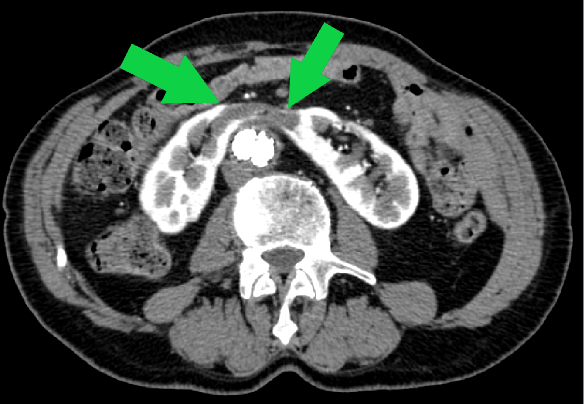 Cureus Horseshoe Kidney Isthmus Infarction After Percutaneous