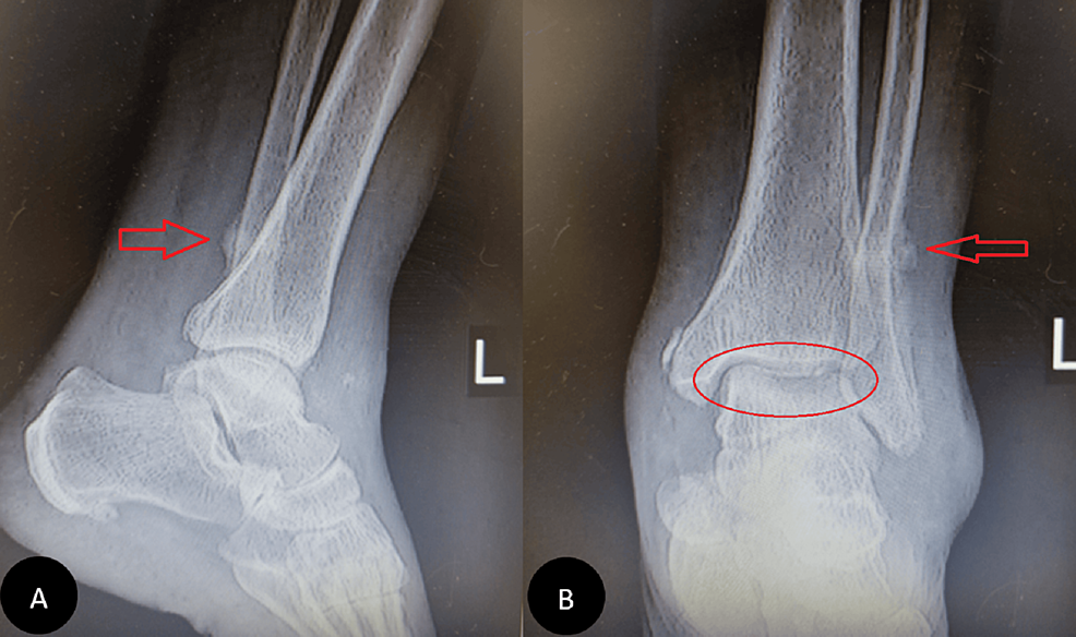 Ankle-X-ray-six-months-after-arthroscopy