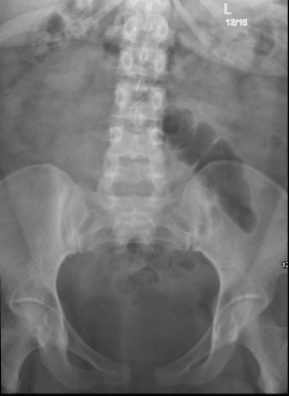 Broken Epidural Catheter After Vaginal Delivery Cureus