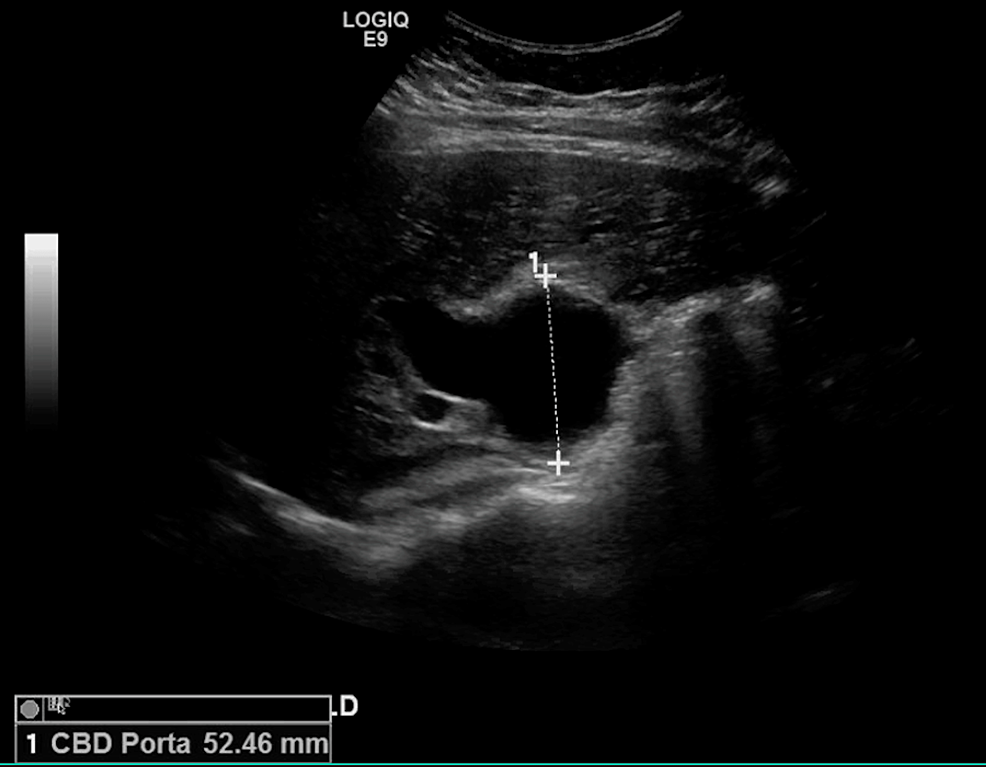 Cureus Biliary Cyst An Unusual Cause of Cholestasis Post Cholecystectomy