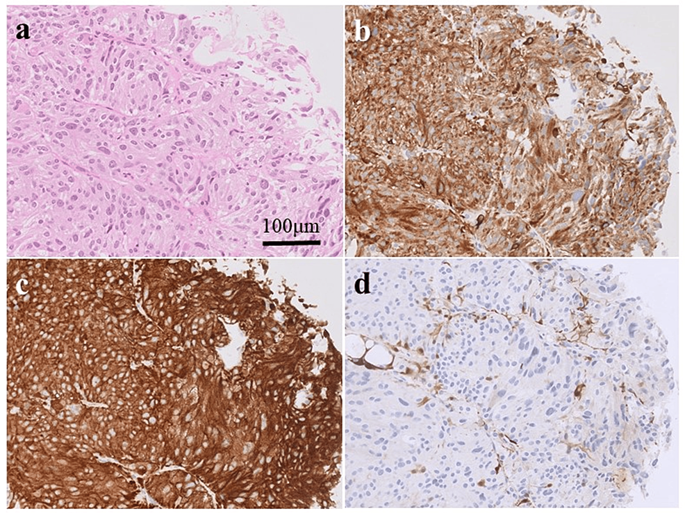 Gamma Knife Radiosurgery An Adjuvant Therapy for Primary Sellar